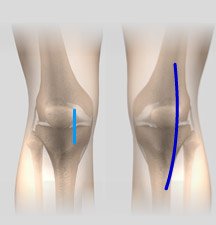 Minimally Invasive Knee Replacement Incisions